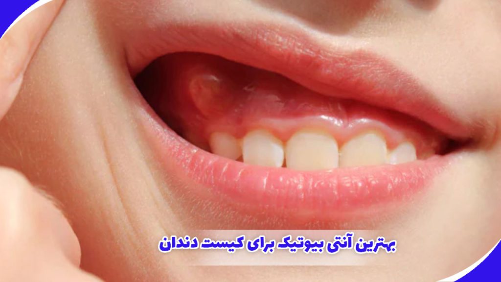 بهترین آنتی بیوتیک برای کیست دندان